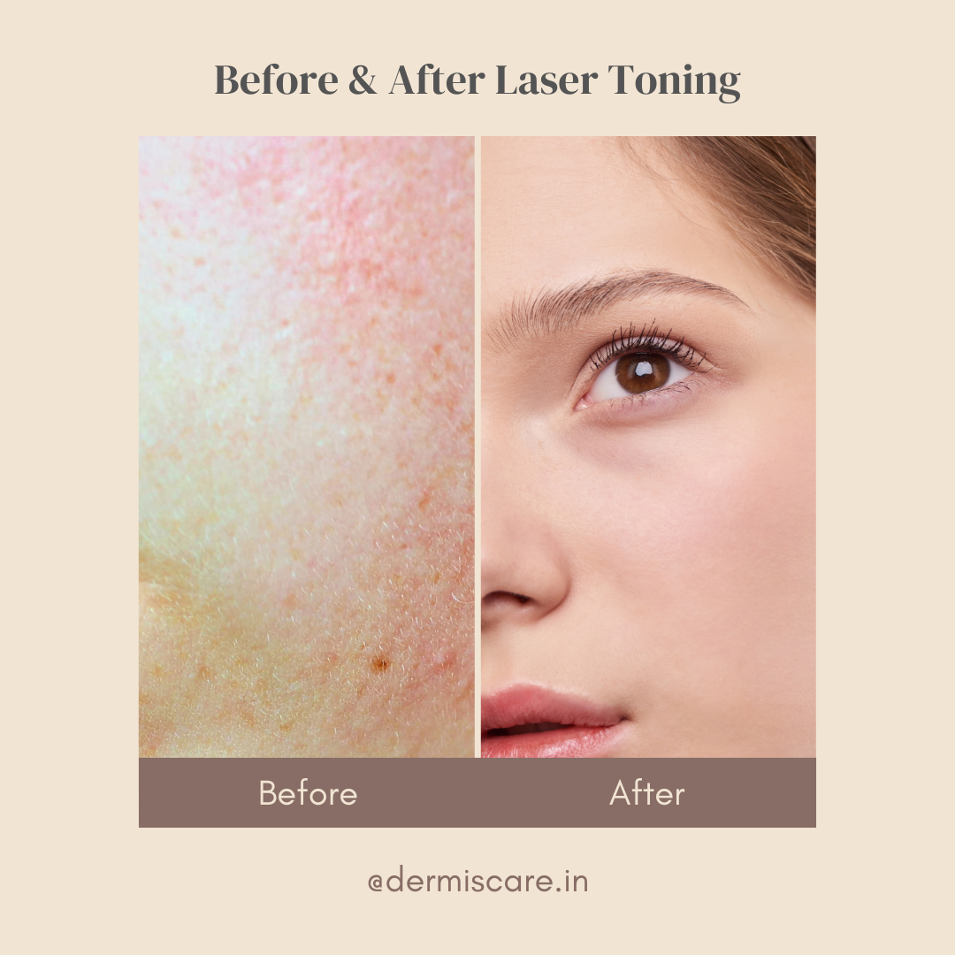 laser-tone